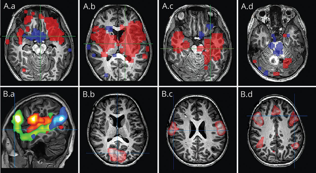 Fmrt Functional Magnetic Resonance Imaging (FMRI)